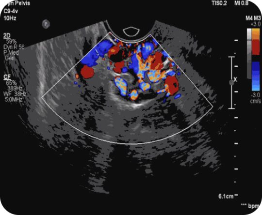 duplex ultrasound